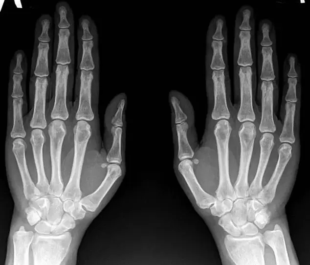 artritis de la articulación de la muñeca en la radiografía antes de usar Hondroine