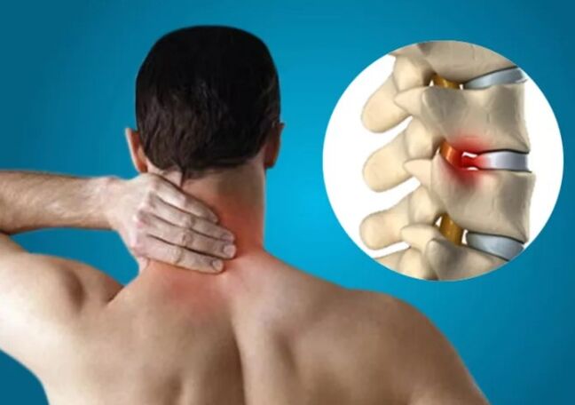 Osteocondrosis cervical