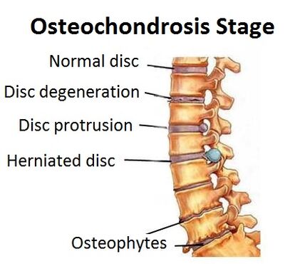 Etapas de la osteocondrosis