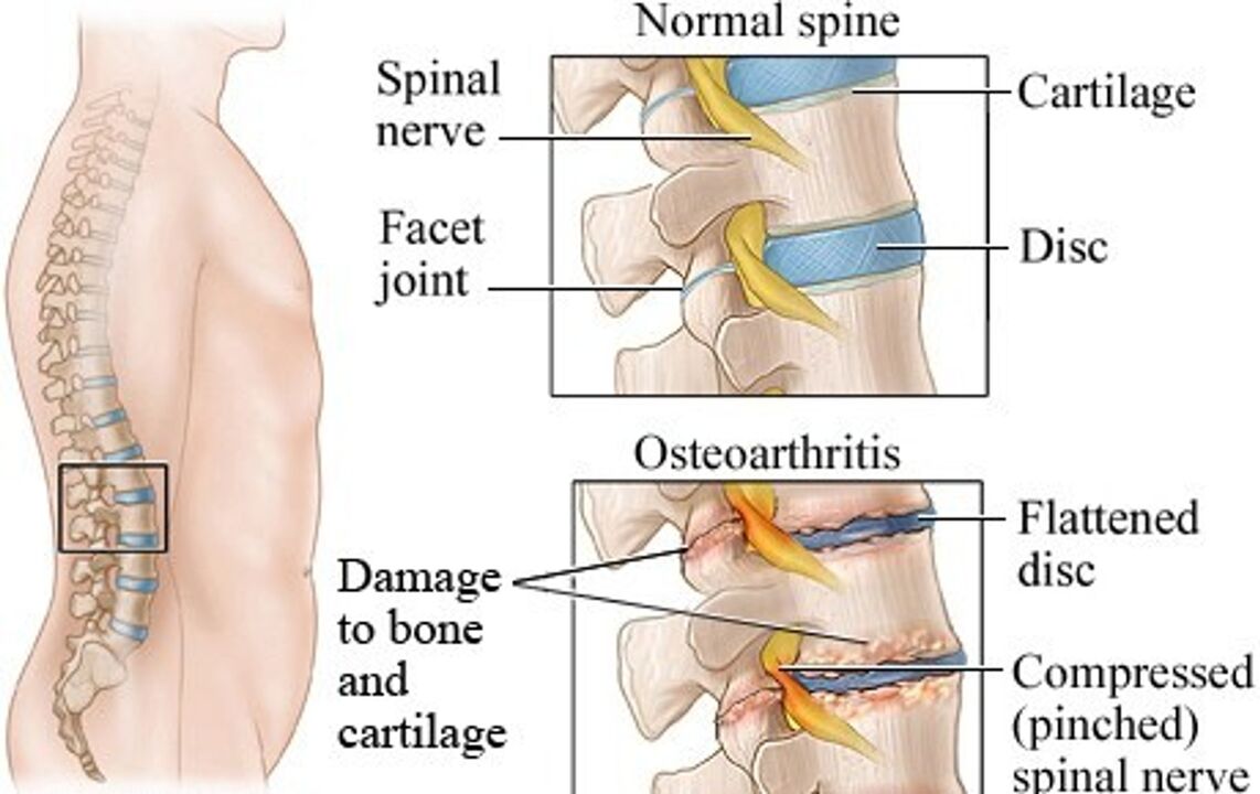 La diferencia entre un disco sano y un disco con osteocondrosis