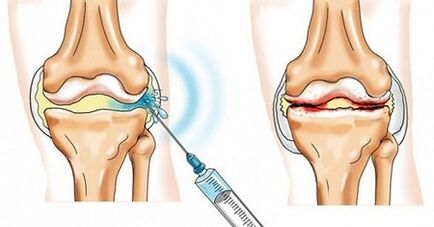 Cómo tratar la artrosis de la articulación de la rodilla