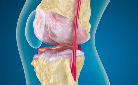 Las razones para el desarrollo de la artrosis de la articulación de la rodilla